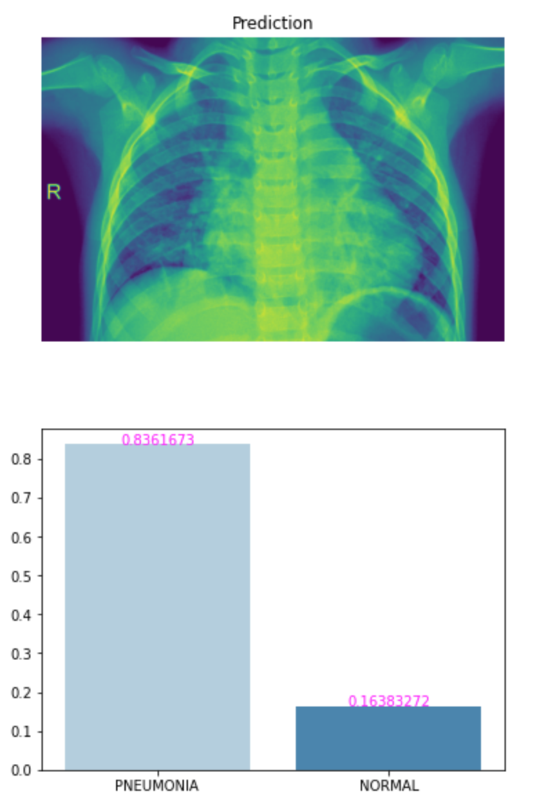Using Deep Learning to detect Pneumonia in X-ray images | onpointai